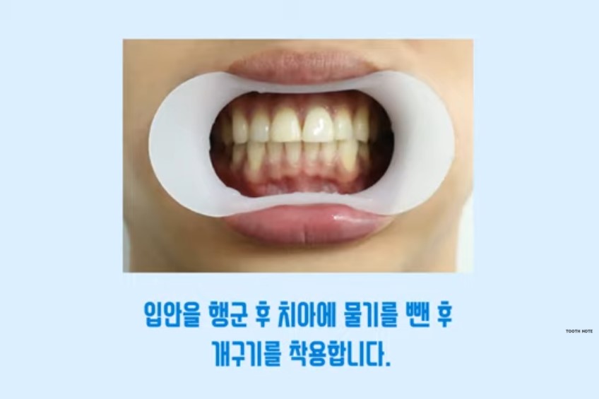 tooth note Teeth Whitening Gel Kit for 2 Weeks, Korean Oral Care